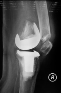 02 - Periprosthetic Fracture of the Knee