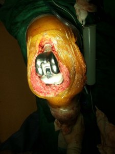 04 - A tumour prosthesis is used