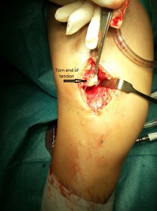 003 - The torn vastus lateralis tendon is identified. By Dr HC Chang