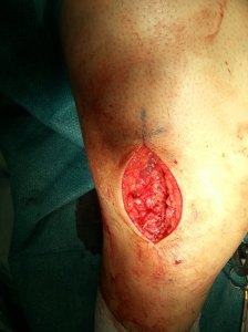 005 - The vastus lateralis after the surgical repair. By Dr HC Chang