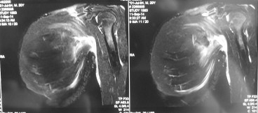 MRI showing left pectoralis major muscle rupture