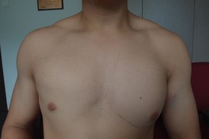 Notice the left nipple is drooped compared to the right nipple. This indicated a possible tear of the left pectoralis major muscle. 