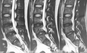 L5/S1 slipped disc in 2012