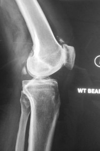 02 - Lateral Left Knee X-rays
