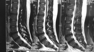 The L5/S1 slipped disc was no longer present in the MRI done in 2015.