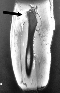 03 - MRI Rectus Femoris Proximal Tear