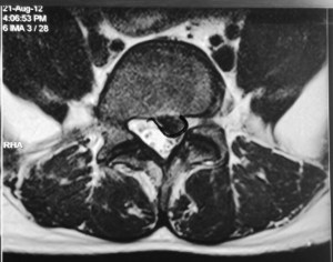 left posterolateral slipped disc at L5/S1 in 2012