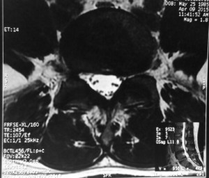 The slipped disc has resorbed.