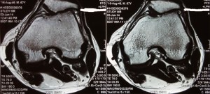 06 - MRI Left Knee