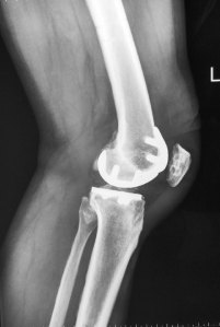 15 - Bicompartmental Knee Makoplasty Lat
