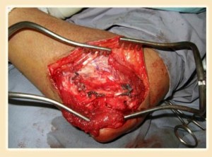 elbow-ligament-reconstruction-3