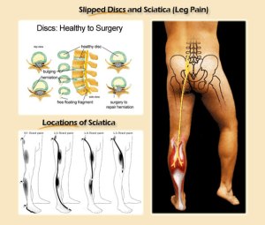 slipped-discs-1