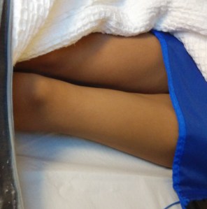 Muscle Wasting in Left Thigh